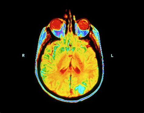 Secondary Brain Cancer Photograph By National Cancer Institute Science