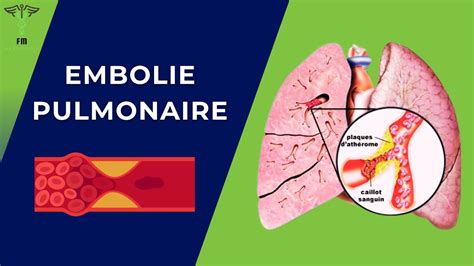 Embolie Pulmonaire Aigue Facteurs De Risques Signes Cliniques