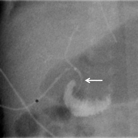 Intraoperative Cholangiography Via The Punctured Gall Bladder