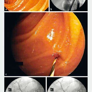 Endoscopic And Radiographic Images Of Endoscopic Treatment Of Patient A