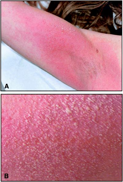 Acute Generalized Exanthematous Pustulosis Agep A Clinical Reaction