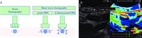 Technique And Principles Of Ultrasound Elastography A The