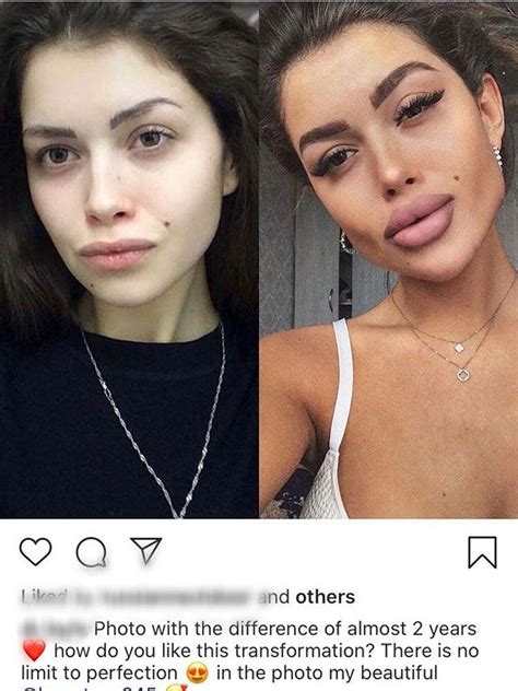 Plastic Surgery Before And After Nose Gone Wrong