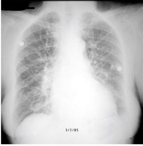 Chest Radiography And Lines Flashcards Quizlet