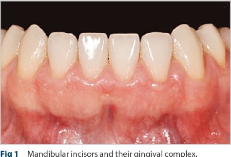 Table 1 From A Simple Method For Measuring Thickness Of Gingiva And