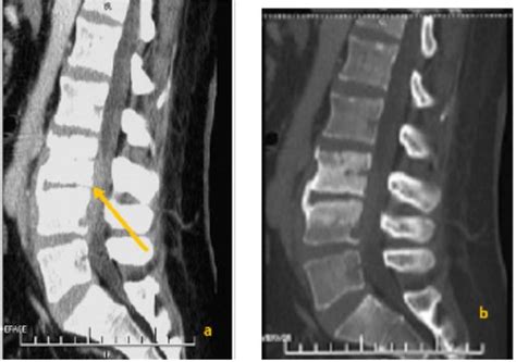 Characteristics And Management Of Brucellosis Related Spondylodiscitis