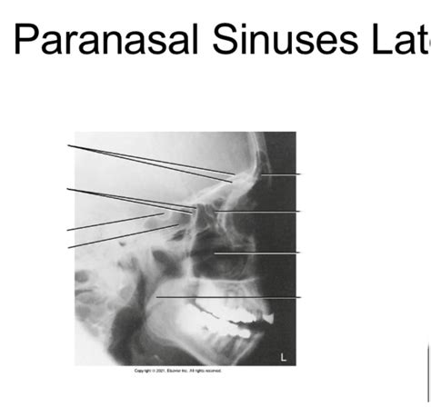 Lateral Paranasal Sinuses Diagram Quizlet