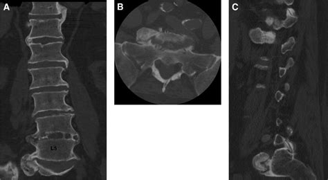 L5 radiculopathy caused by L5 nerve root entrapment by an L5 - EroFound