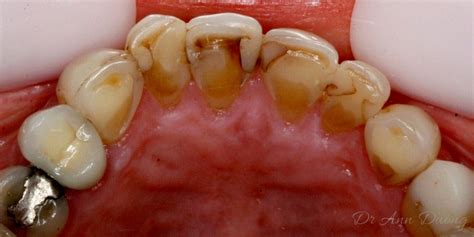 Dental Crowns Before And After