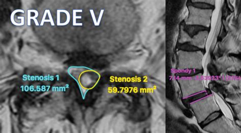 NeuroSpine Surgery Research Group NSURG Classification System For