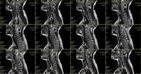 Set Sagittale Mri Scans Van Nekgebied Van Blanke 34 Jarige Man Met