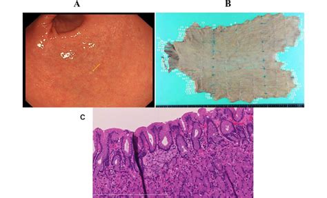 Esophagogastroduodenoscopy Post Operative Specimen And Pathological Download Scientific