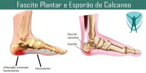 Corpore Physio Max Cpx Itc Vertebral Fascite Plantar E Espor O De Hot