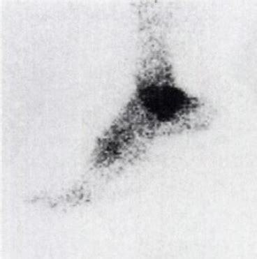 The Os Trigonum Syndrome - Physiopedia