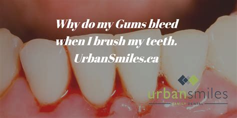 Why Do My Gums Bleed When I Brush My Teeth Urban Smiles Edmonton Dentist