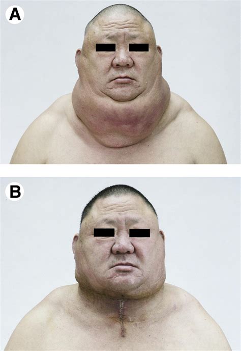 Surgical Treatment Of Multiple Symmetric Lipomatosis Madelungs