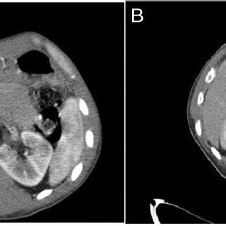 (A) Abdominal CT scan in at the time of diagnosis, (B) Abdominal CT ...