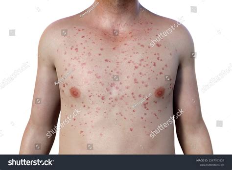 Dengue Hemorrhagic Fever Rash