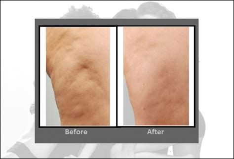 Cellulaze Before And After 2