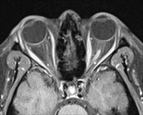 Optic Neuritis Mri