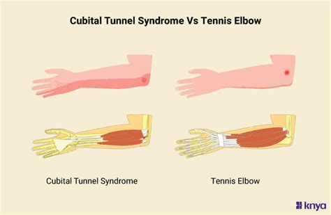 Cubital Tunnel Vs Tennis Elbow Features Similarities And Differences