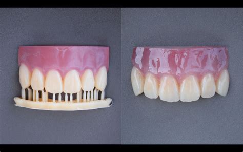 Digital Dentures With 3d Printing Formlabs Dental