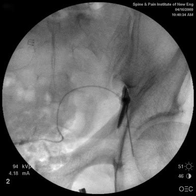 Sciatic Nerve Block | Musculoskeletal Key