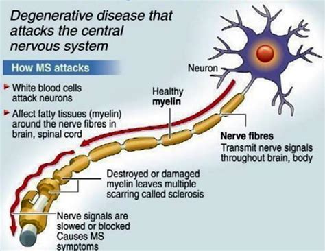 About Health Multiple Sclerosis