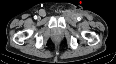 Computerized tomography image. Right inguinal adenopathy (white arrow)... | Download Scientific ...