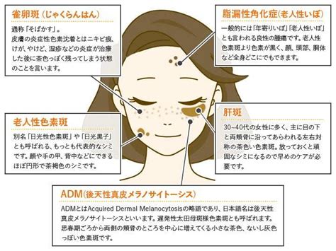 シミの原因と見分け方 銀座・新宿の美容皮膚科エルクリニック【公式】