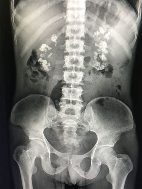 Bilateral Medullary Nephrocalcinosis Renal Life And Death X Ray