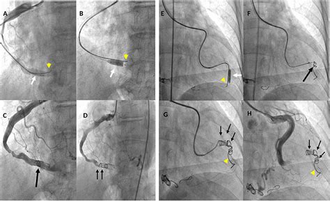 Frontiers Case Report Coil Occlusion Of Two Congenital Coronary