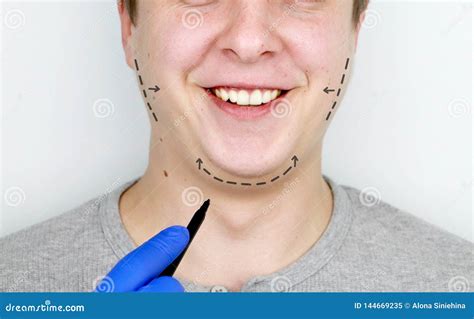 Chin Lift Mentoplasty A Man At The Reception At The Plastic Surgeon