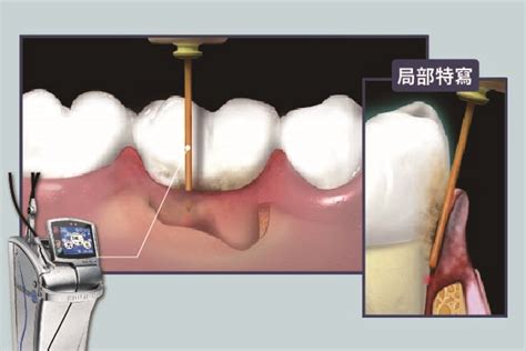 水雷射｜牙周病治療的神隊友【竹北牙周病治療推薦】