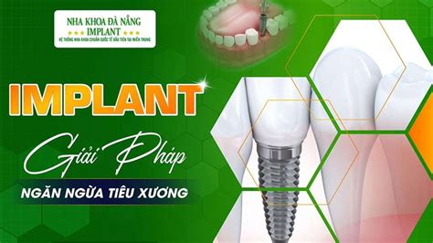 Cấu tạo Implant nha khoa là gì Nên trồng trụ implant nào tốt