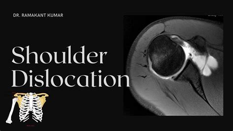 Shoulder Dislocation Treatment Dislocated Shoulder Recovery