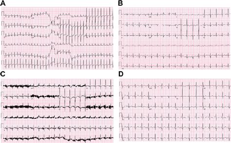 A Patients Presenting Rhythm A Narrow Complex Short RP Tachycardia