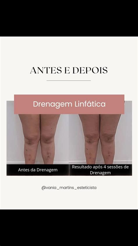 Joelho Gordo Antes E Depois - Bater Joelhos Antes E Depois Caroço No Joelho: O Que Pode Ser? Tem