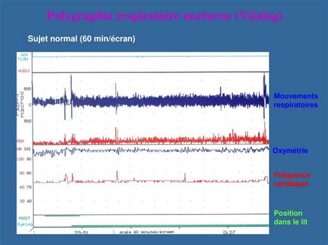 PPT Le Syndrome des Apnées Obstructives du Sommeil OSAS PowerPoint