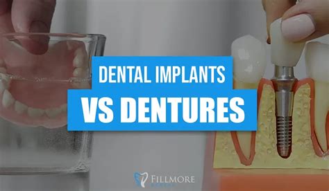 Dental Implants Vs Dentures Whats Right For You