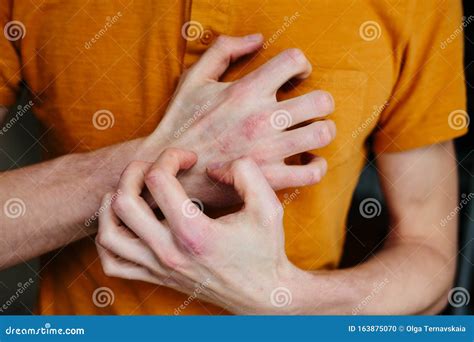 Man Scratch Oneself Dry Flaky Skin On Hand With Psoriasis Vulgaris