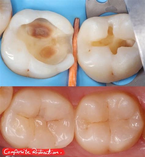 Tooth Filling Composite Restoration Before And After Tooth Filling Old