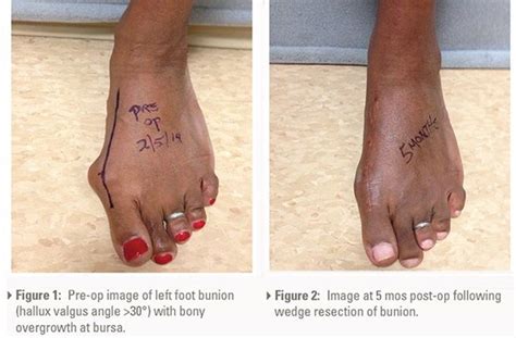 Surgical Management Of Foot And Toe Subcutaneous Tissue Ankle