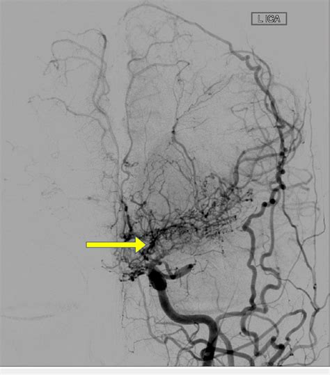 Cerebral Angiogram Wherein The Left Internal Carotid Artery Ica Shows