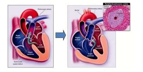 Eisenmenger syndrome: causes, symptoms, diagnosis, treatment | Health 2025