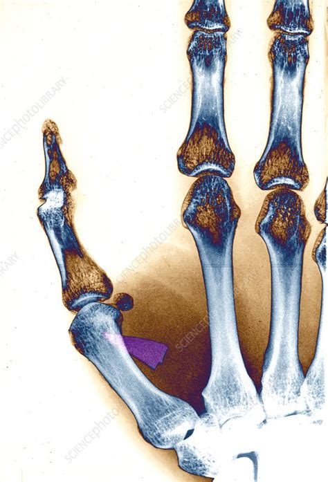 Glass Shard In Thumb X Ray Stock Image C0371608 Science Photo Library