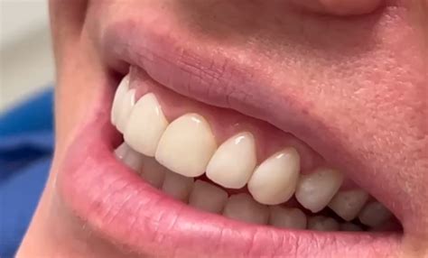 Faccette Dentali A Roma Cosa Sono E A Cosa Servono