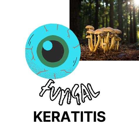 Fungal Keratitis - Causes, Symptoms, Diagnosis, Treatment,6 ...