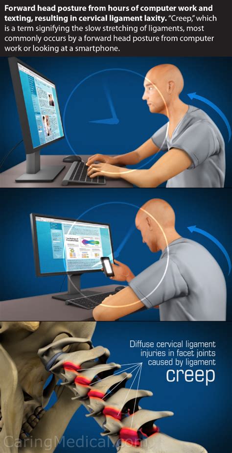 Forward Head Posture Symptoms And Complications