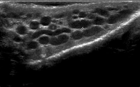 Venous Embolization Case Albany Ir